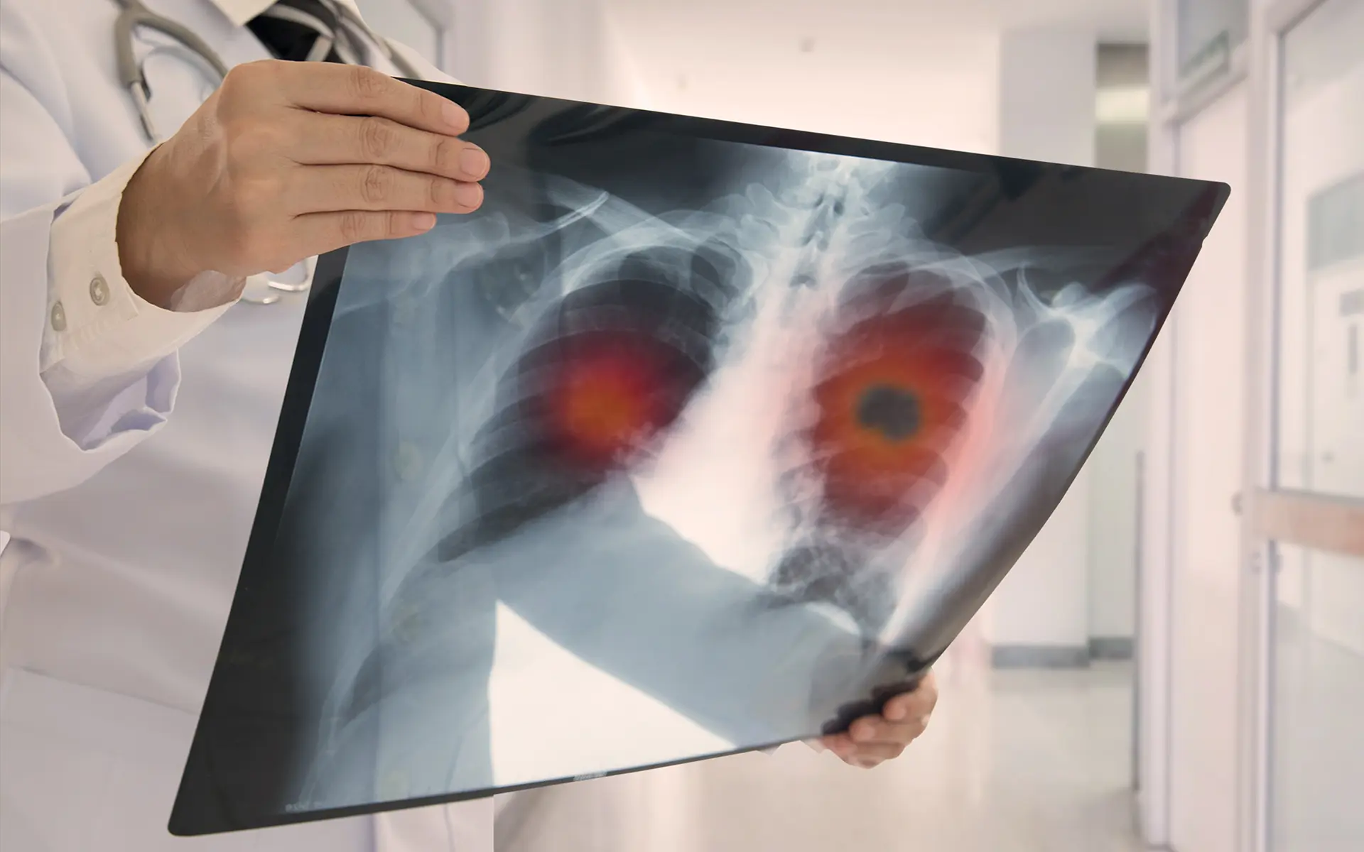 Closeup of a doctor looking at the x-ray results of asbestosis.