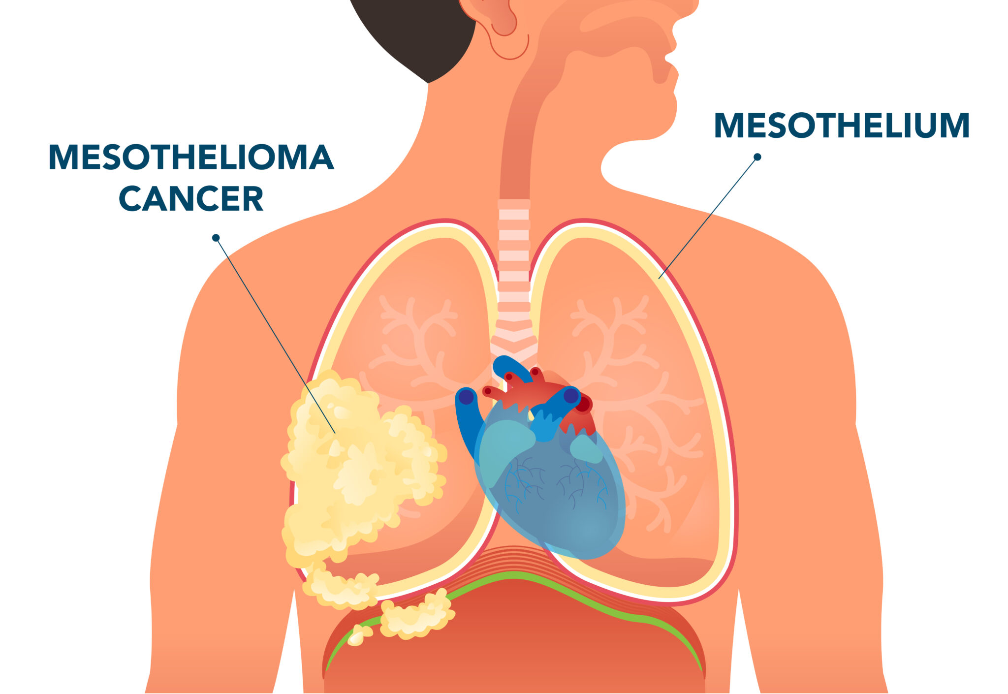Photo of a chest diagram showing the mesothelium layer.