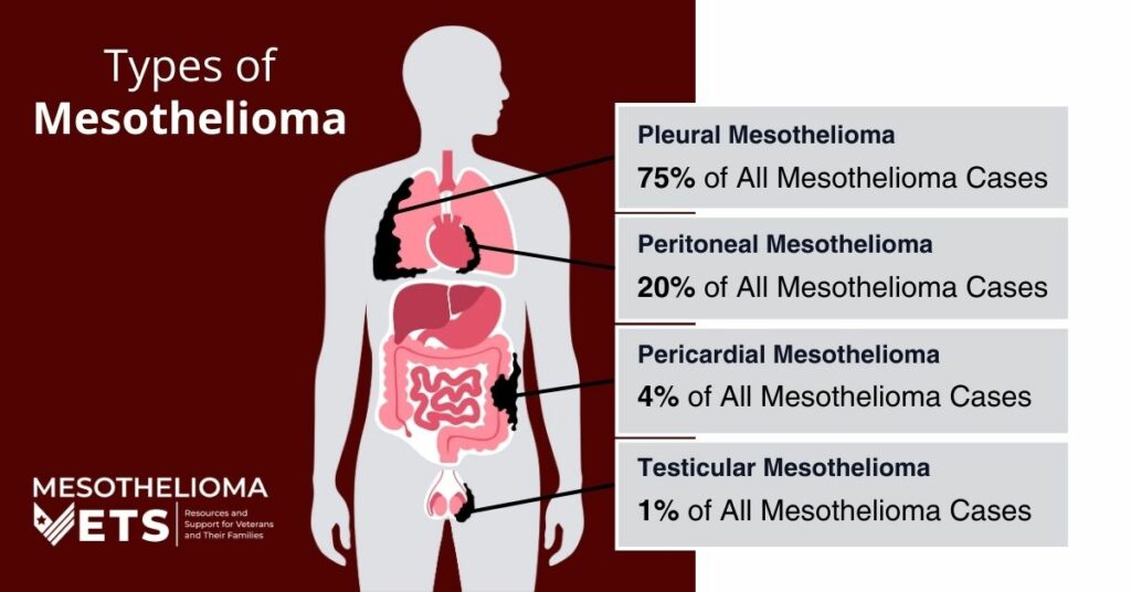 Infographic detailing the types of mesothelioma, including pleural mesothelioma, peritoneal mesothelioma, pericardial mesothelioma, and testicular mesothelioma and the percentage of cases each mesothelioma type has.