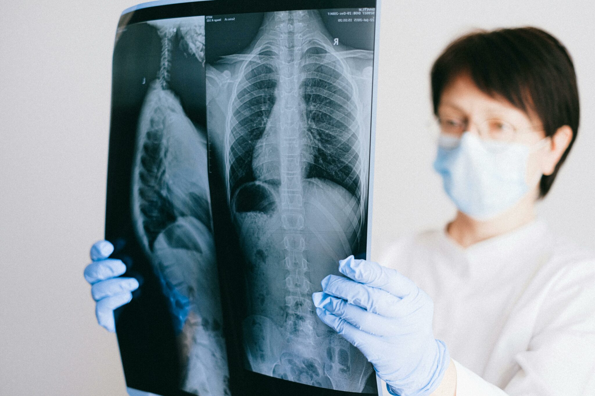 Female doctor in mask and gloves holding x ray scan of lungs after a lung cancer screening
