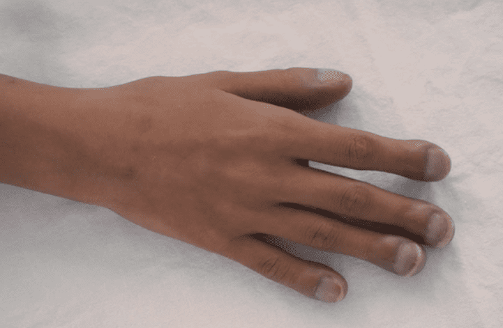 A picture of someone with clubbed fingers, possibly due to asbestos exposure.